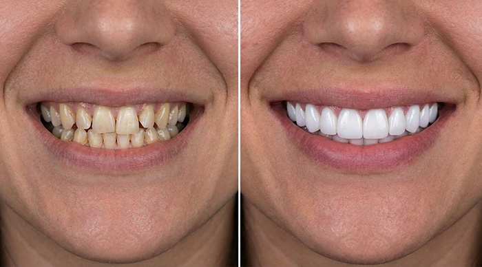 Smile Transformation Before and After